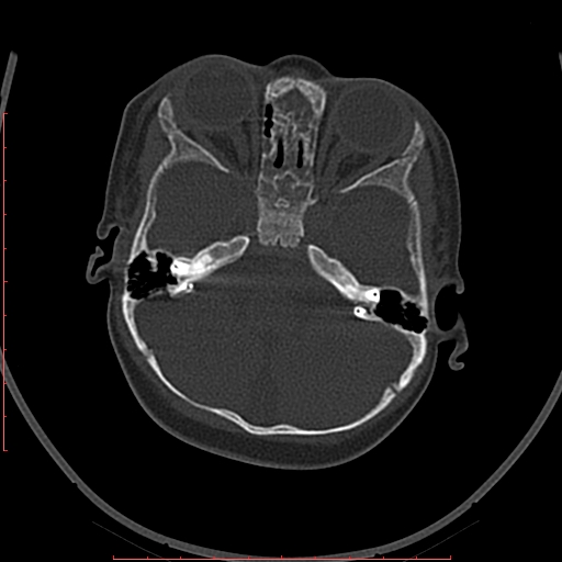File:Calcified middle cerebral artery embolism (Radiopaedia 78949-91860 Axial bone window 8).jpg