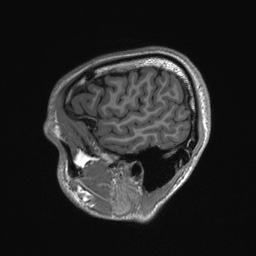Callosal dysgenesis with interhemispheric cyst (Radiopaedia 53355-59335 Sagittal T1 151).jpg
