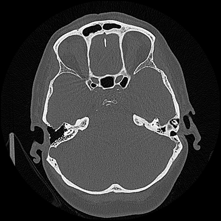 Canal up mastoidectomy (Radiopaedia 78108-90638 Axial bone window 99).jpg