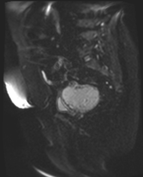 Cancer cervix - stage IIb (Radiopaedia 75411-86615 Sagittal DWI 39).jpg