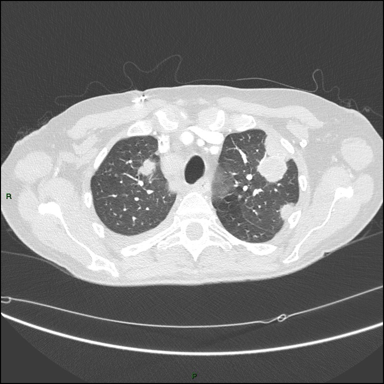 Cannonball metastases (Radiopaedia 82110-96150 Axial lung window 52).jpg