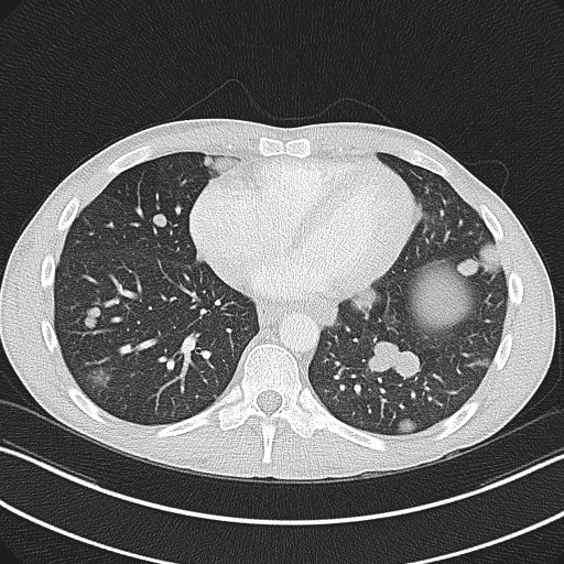 File:Cannonball metastases - testicular choriocarcinoma (Radiopaedia 84510-99891 Axial lung window 68).jpg