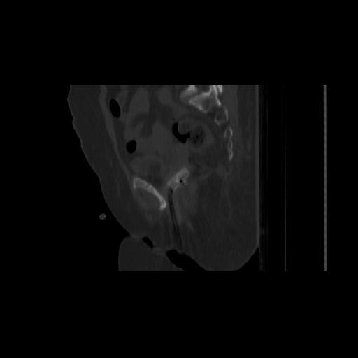 Carcinoma cervix- brachytherapy applicator (Radiopaedia 33135-34173 Sagittal bone window 69).jpg
