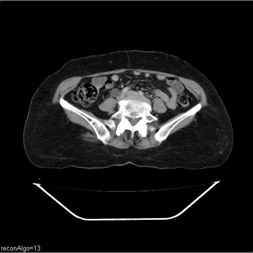 File:Carcinoma cervix- recurrence (Radiopaedia 34702-36137 B 35).jpg