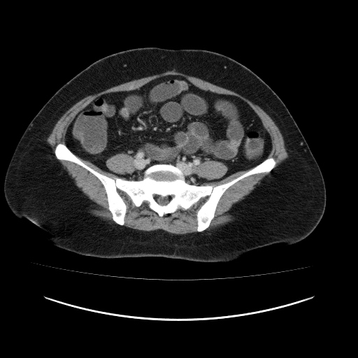 File:Carcinoma colon - hepatic flexure (Radiopaedia 19461-19493 A 90).jpg