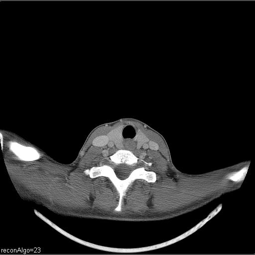 File:Carcinoma of the maxillary antrum (Radiopaedia 53805-59888 Axial C+ delayed 9).jpg