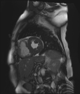 Cardiac amyloidosis (Radiopaedia 51404-57150 Sagittal CINE SSFP 163).jpg