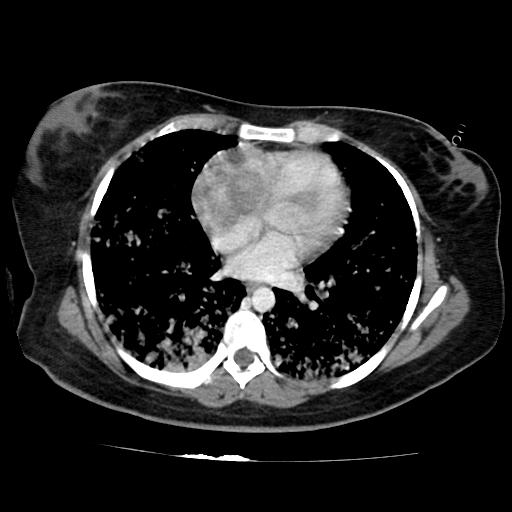 File:Cardiac angiosarcoma (Radiopaedia 66010-75181 B 113).jpg
