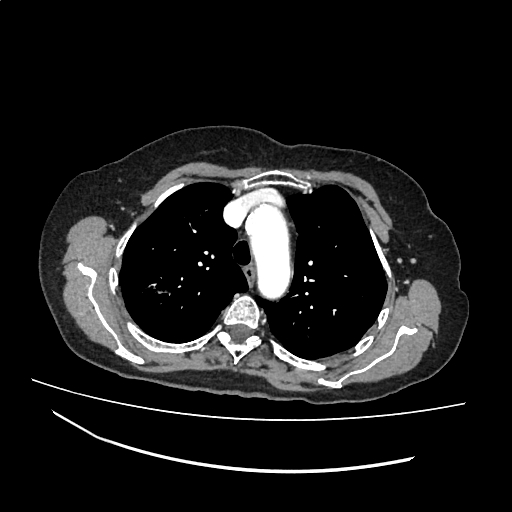 File:Cardiac hydatid disease (Radiopaedia 64684-73611 Axial with contrast 12).jpg