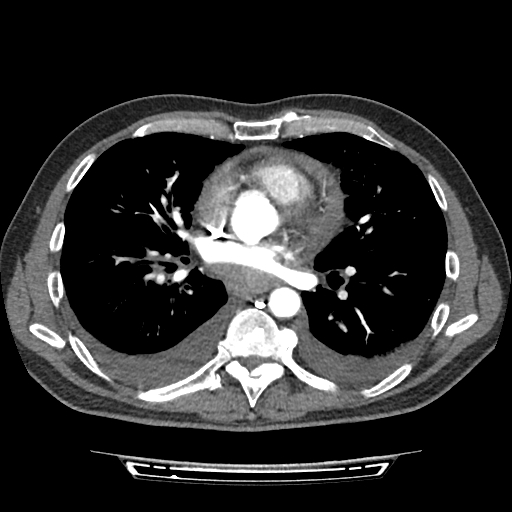 Cardiac tamponade (Radiopaedia 78607-91368 Axial C+ CTPA 48).jpg
