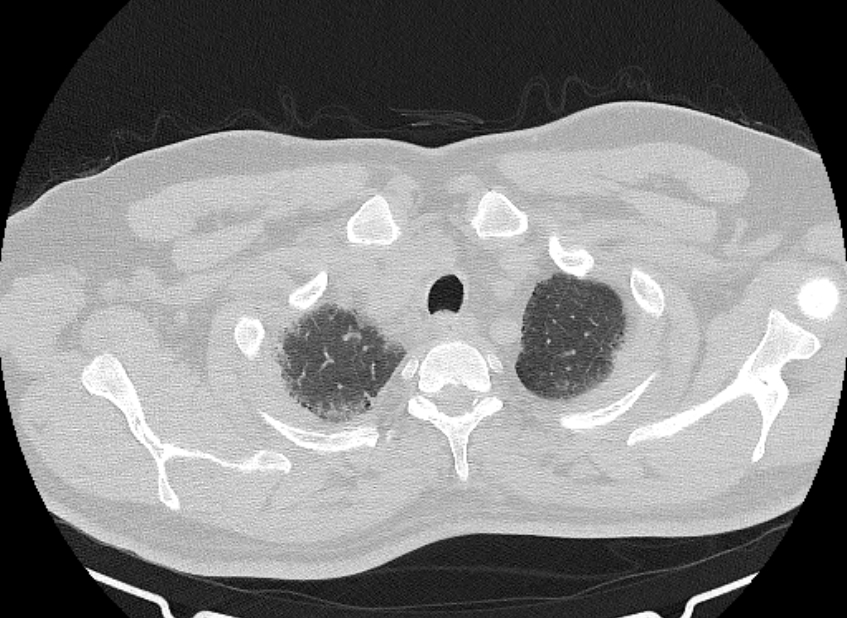 Cardiogenic pulmonary edema (Radiopaedia 68180-77678 Axial lung window 6).jpg