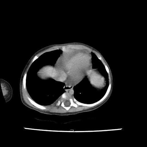 Caroli disease with autosomal recessive polycystic kidney disease (ARPKD) (Radiopaedia 89651-106703 B 10).jpg