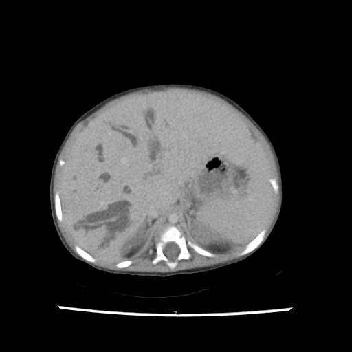 File:Caroli disease with autosomal recessive polycystic kidney disease (ARPKD) (Radiopaedia 89651-106703 B 51).jpg