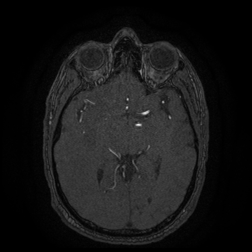 File:Carotid arterial dissection with acute cerebral infarction (Radiopaedia 26636-26784 MRA 89).jpg