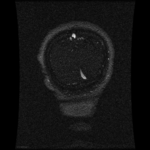 Carotid arterial dissection with acute cerebral infarction (Radiopaedia 26636-26784 MRV 39).jpg