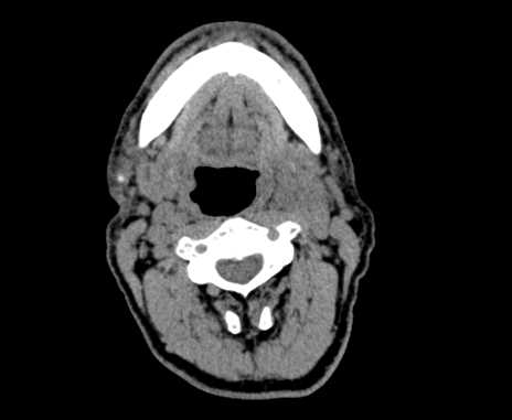 Carotid body tumor (Radiopaedia 61750-69757 Axial non-contrast 40).jpg