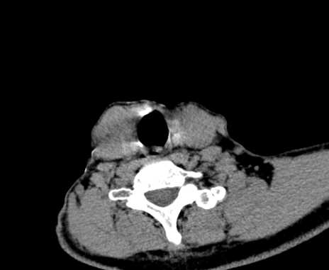 Carotid body tumor (Radiopaedia 61750-69757 Axial non-contrast 88).jpg