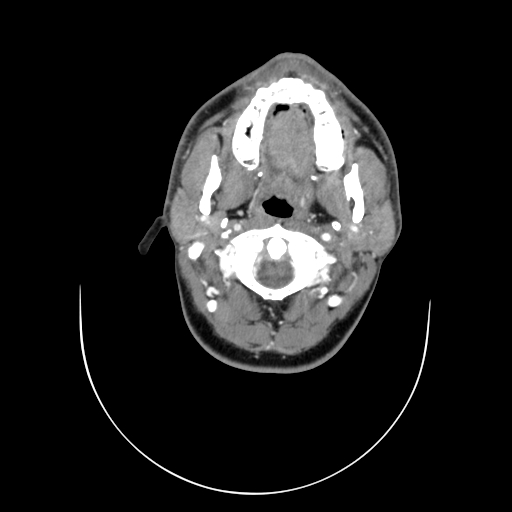 File:Carotid bulb pseudoaneurysm (Radiopaedia 57670-64616 A 12).jpg