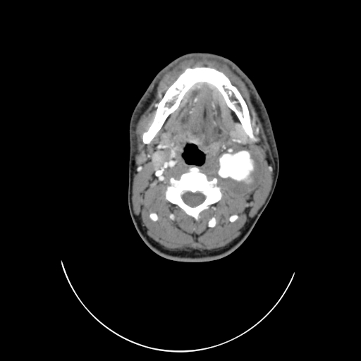 File:Carotid bulb pseudoaneurysm (Radiopaedia 57670-64616 A 27).jpg