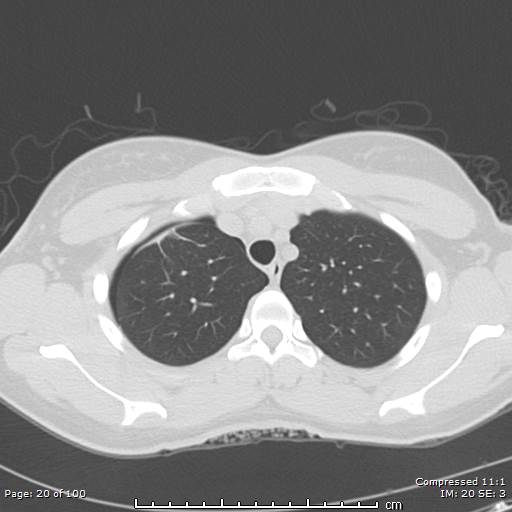 Catamenial pneumothorax (Radiopaedia 54382-60600 Axial non-contrast 20).jpg