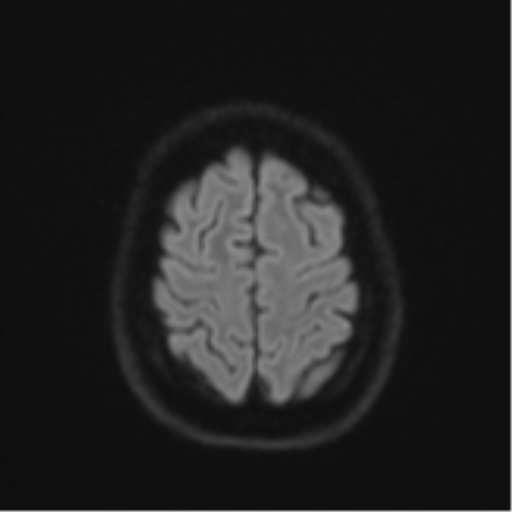 File:Cavernoma with bleed - midbrain (Radiopaedia 54546-60774 Axial DWI 51).png