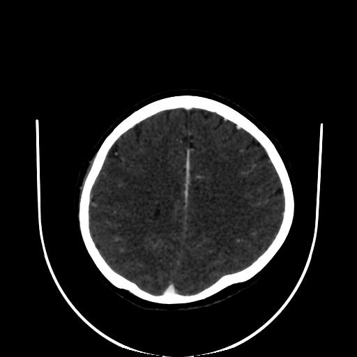 Cavernoma with developmental venous anomaly (Radiopaedia 22470-22506 C 128).jpg