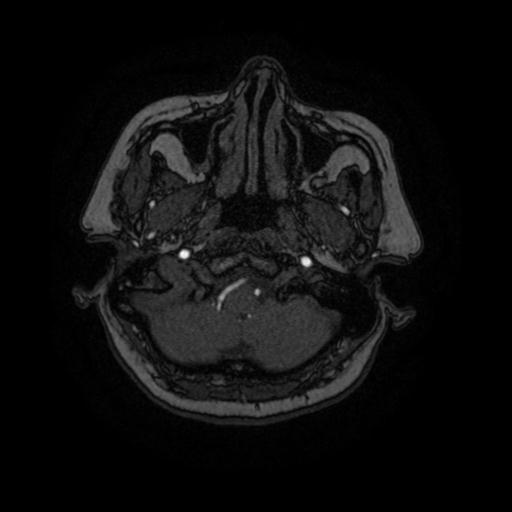 Cavernoma with developmental venous anomaly (Radiopaedia 22470-22507 MRA 91).jpg