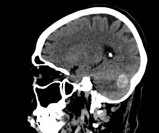 Cavernous hemangioma of the cerebellar falx (Radiopaedia 73025-83723 B 212).jpg