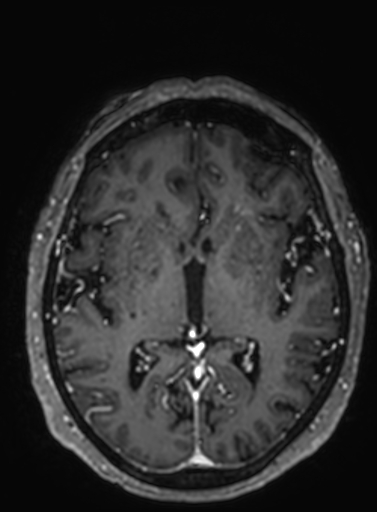 Cavernous hemangioma of the cerebellar falx (Radiopaedia 73025-83724 Axial T1 C+ 168).jpg