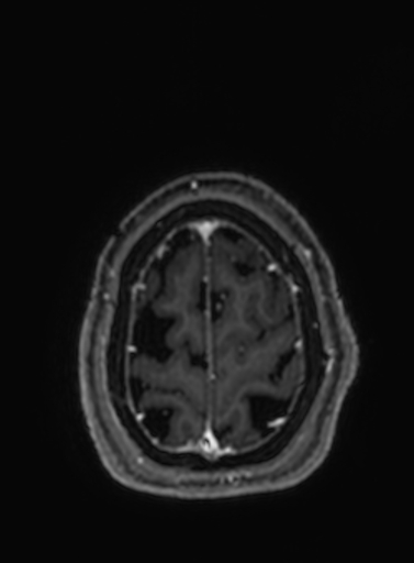 File:Cavernous hemangioma of the cerebellar falx (Radiopaedia 73025-83724 Axial T1 C+ 45).jpg