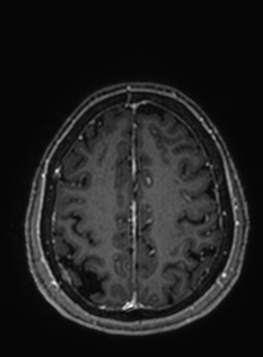 File:Cavernous hemangioma of the cerebellar falx (Radiopaedia 73025-83724 Axial T1 C+ 88).jpg
