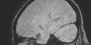 Cavernous hemangioma of the cerebellar falx (Radiopaedia 73025-83724 Sagittal BOLD 148).jpg