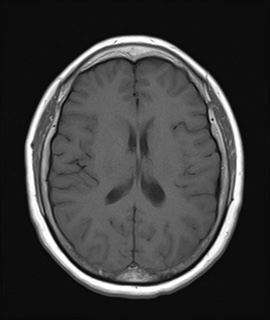 File:Cavernous sinus meningioma (Radiopaedia 63682-72367 Axial T1 14).jpg