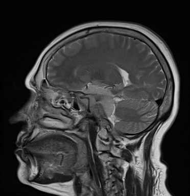 File:Cavernous sinus meningioma (Radiopaedia 63682-72367 Sagittal T2 8).jpg