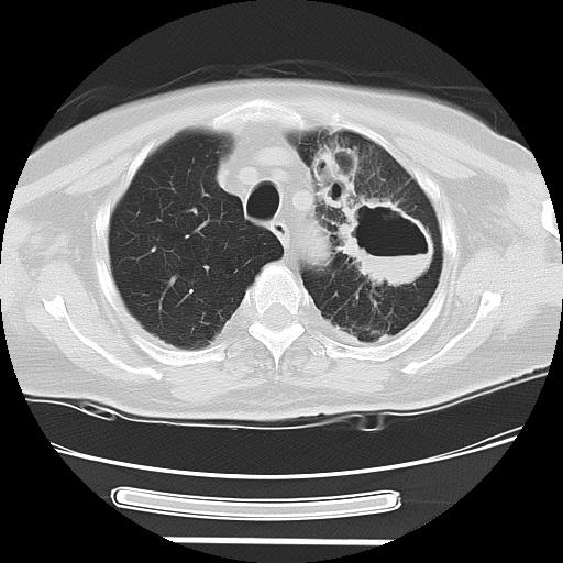 Cavitating pulmonary metastases (Radiopaedia 89545-106544 Axial lung window 13).jpg