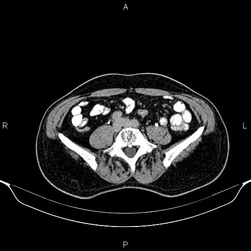 Cecal adenocarcinoma (Radiopaedia 85324-100916 Axial C+ delayed 64).jpg