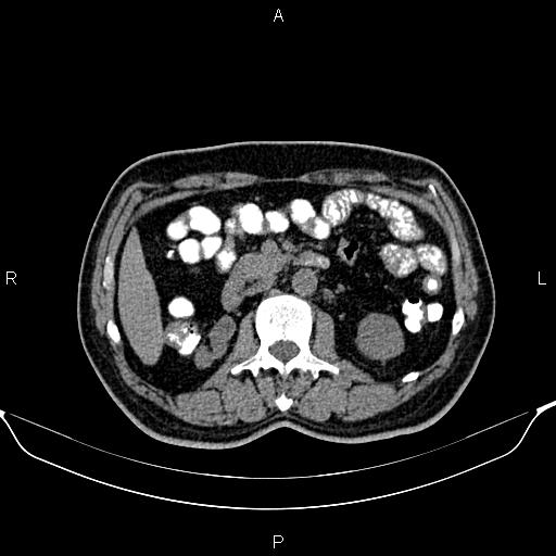 Cecal adenocarcinoma (Radiopaedia 85324-100916 Axial non-contrast 40).jpg