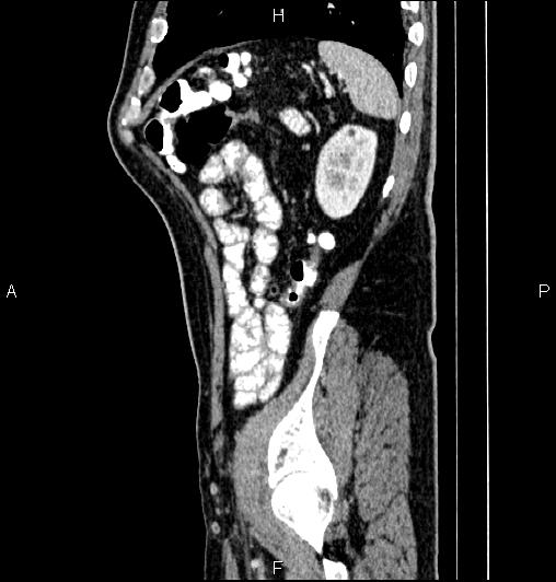 Cecal adenocarcinoma (Radiopaedia 85324-100916 E 76).jpg