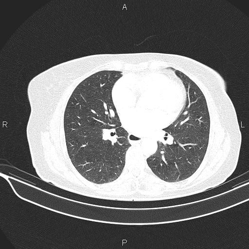 Cecal cancer (Radiopaedia 85610-101358 Axial lung window 37).jpg
