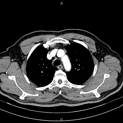File:Cecal cancer with appendiceal mucocele (Radiopaedia 91080-108651 A 19).jpg