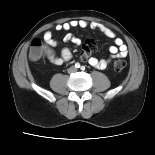 Cecal mass causing appendicitis (Radiopaedia 59207-66531 A 53).jpg