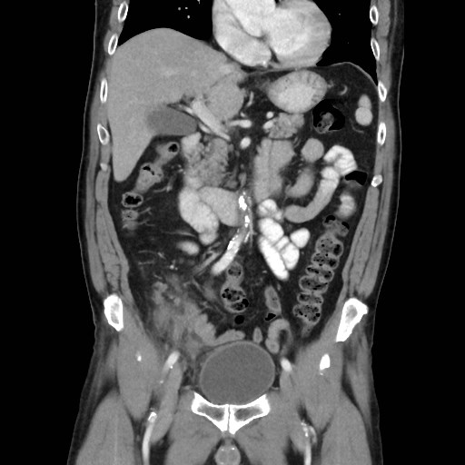 Cecal mass causing appendicitis (Radiopaedia 59207-66531 B 23).jpg