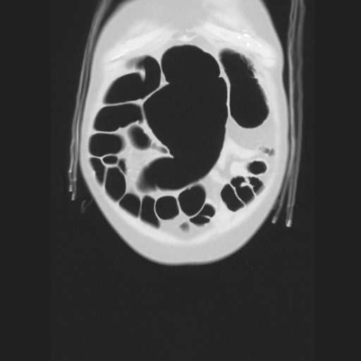 Cecal volvulus (Radiopaedia 75378-86620 Coronal lung window 28).jpg