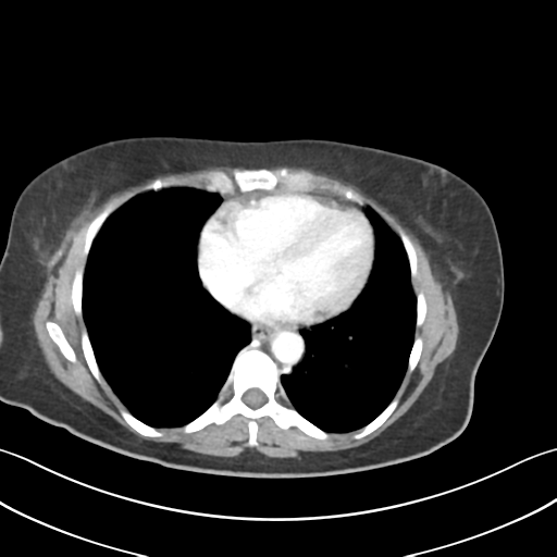 File:Cecum hernia through the foramen of Winslow (Radiopaedia 46634-51112 A 1).png