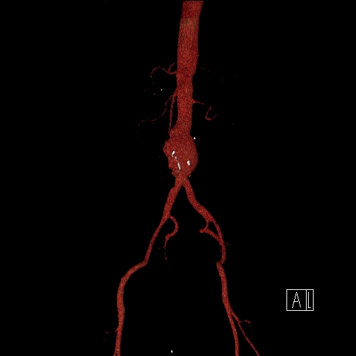 File:Celiac artery compression by the diaphragmatic crurae (Radiopaedia 31739-32666 3D CTA 18).jpg