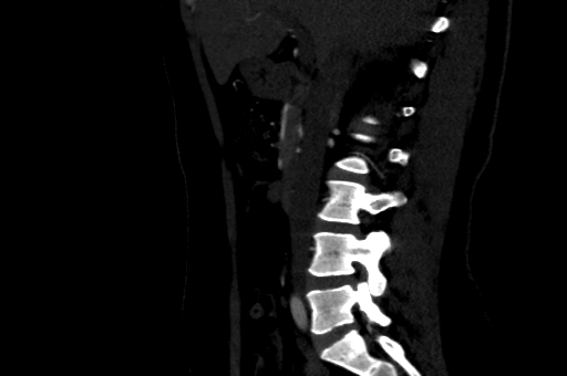 Celiac artery compression syndrome (Radiopaedia 47538-52152 B 2).jpg
