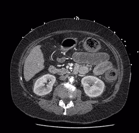 Celiac artery severe stenosis and dissection (Radiopaedia 44128-47842 B 40).jpg