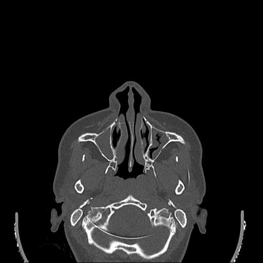 File:Cemento-ossifying fibroma (Radiopaedia 21243-21149 Axial bone window 5).jpg
