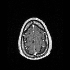 Central-variant posterior reversible encephalopathy syndrome (PRES) (Radiopaedia 43880-47358 Axial T1 C+ 154).jpg