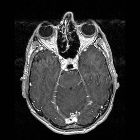 File:Central-variant posterior reversible encephalopathy syndrome (PRES) (Radiopaedia 43880-47358 Axial T1 C+ 48).jpg